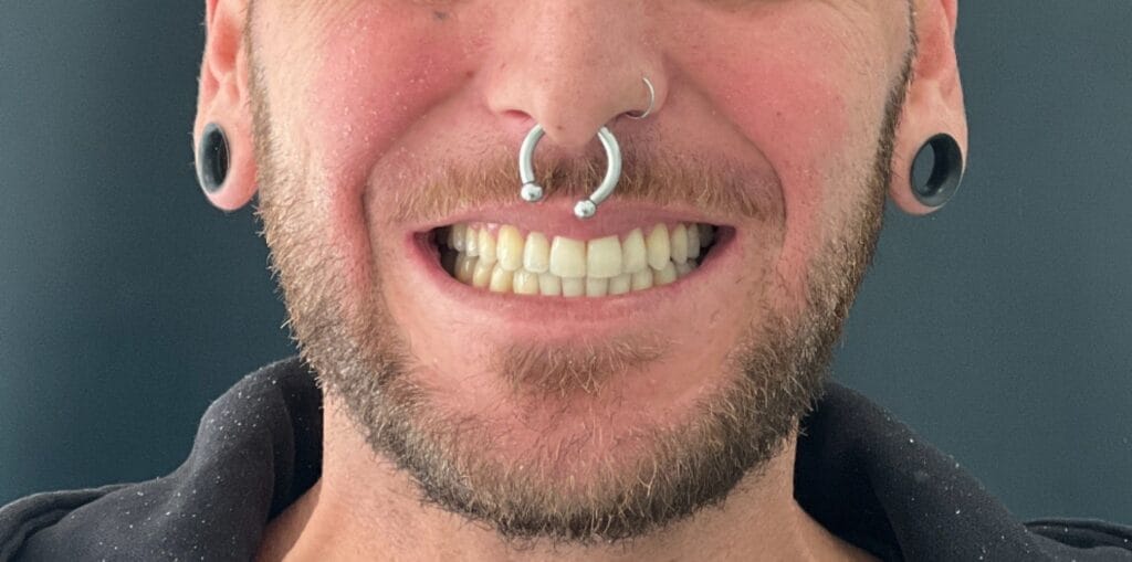 Ortodoncia con alineadores transparentes - Clínicas Chafarinas - Almería