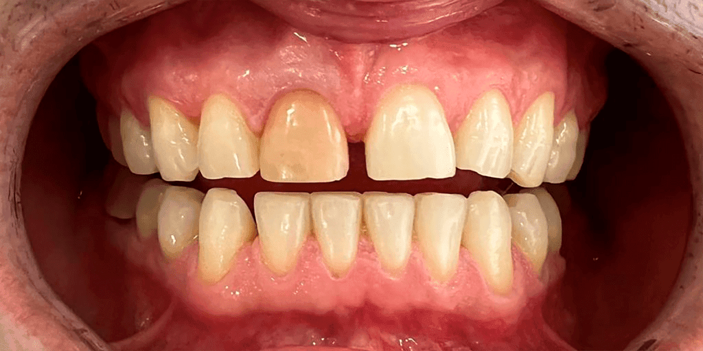 Tratamiento discromía dental - Clínica Chafarinas - Almería