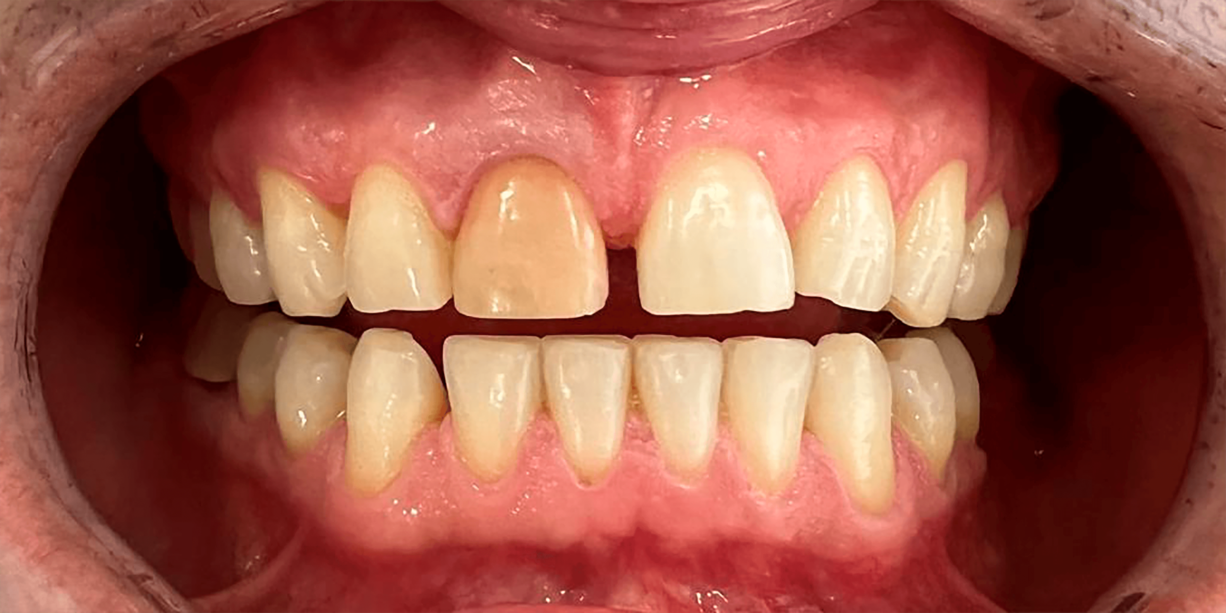 Corrección de Discromía Dental con Coronas de Zirconio