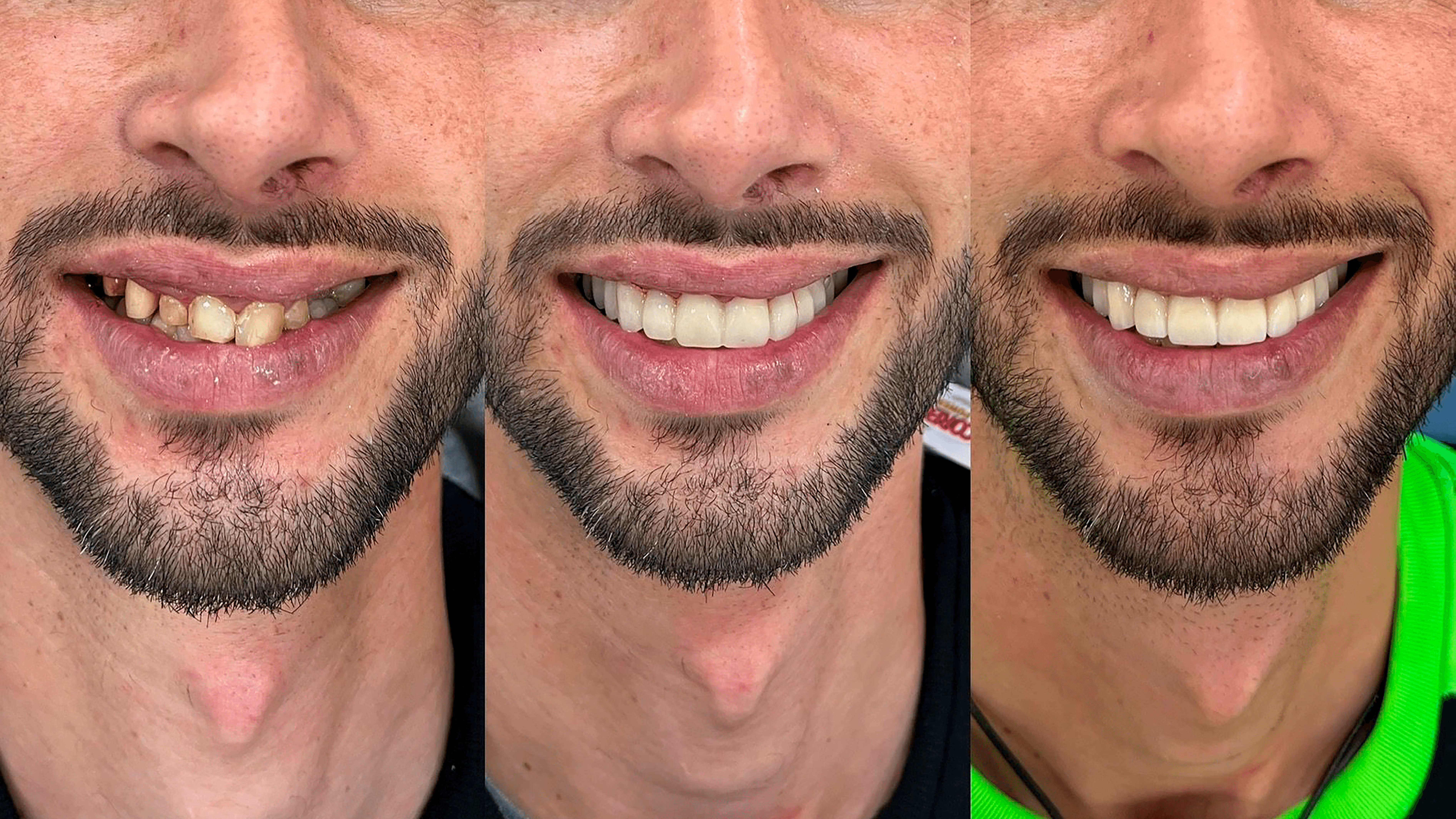 Rehabilitación Dental con Coronas de Zirconio: Recupera tu Sonrisa