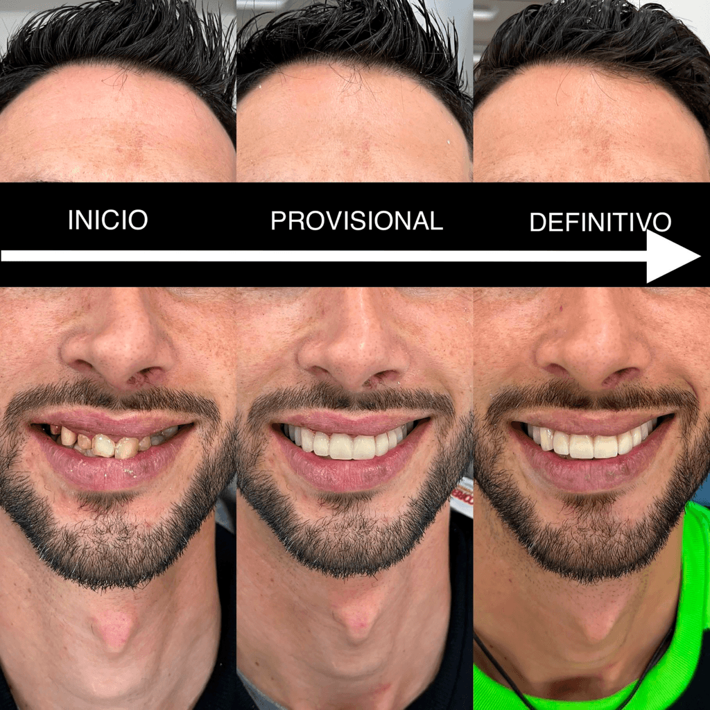 Rehabilitación Dental con Coronas de Zirconio - Clínicas Chafarinas - Almería