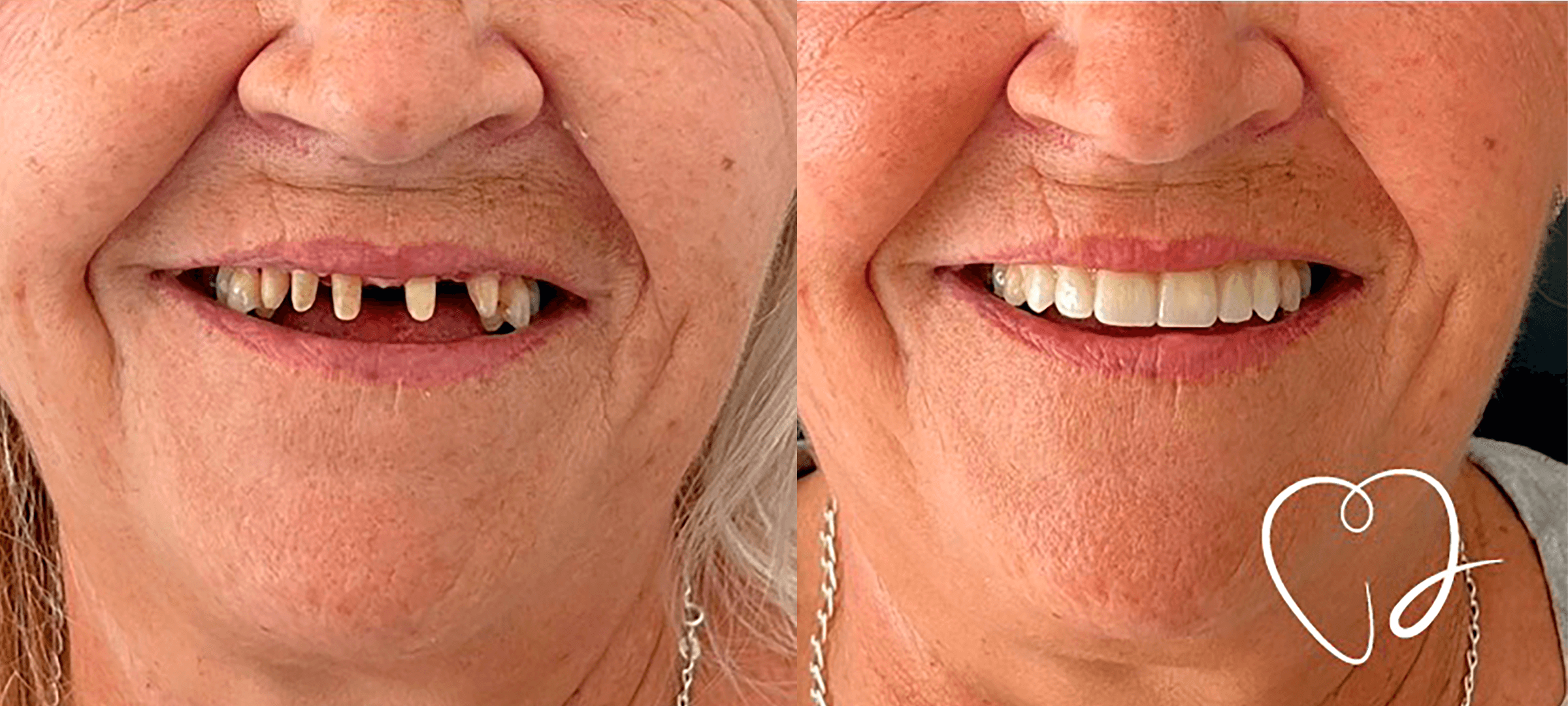 Periodontitis rehabilitada con Coronas de Zirconio: Caso de Éxito