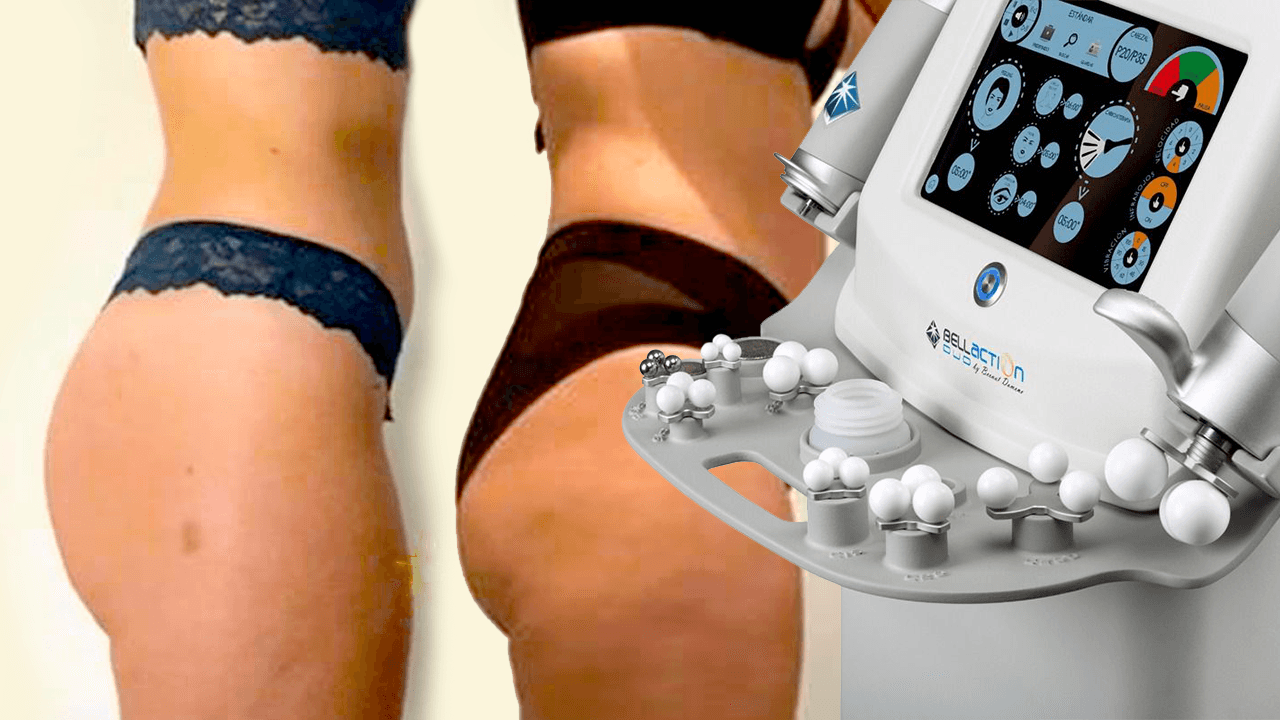 Descubre Bellaction: el tratamiento revolucionario para tu bienestar en Clínicas Chafarinas, Almería