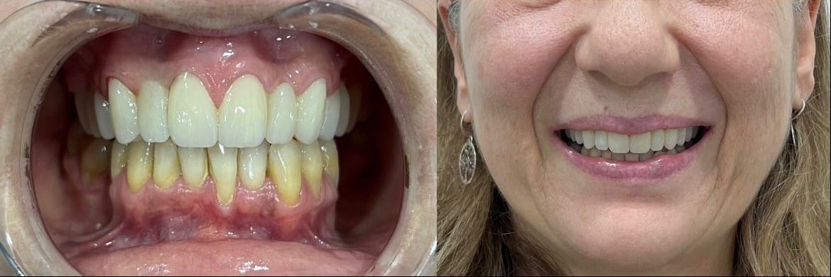 Carillas de Composite: La Solución Perfecta para una Sonrisa Radiante
